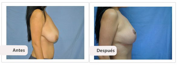 T invertida Mc Kissock: Perfil Caso 5