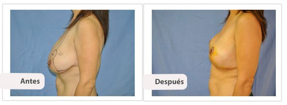 T invertida Mc Kissock: Perfil Caso 6