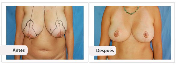 T invertida Mc Kissock: Caso 7