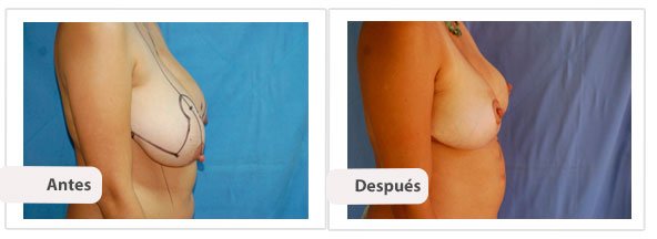 T invertida Mc Kissock: Perfil Caso 7