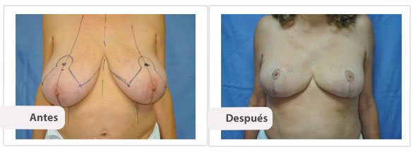 T invertida Mc Kissock: Caso 8