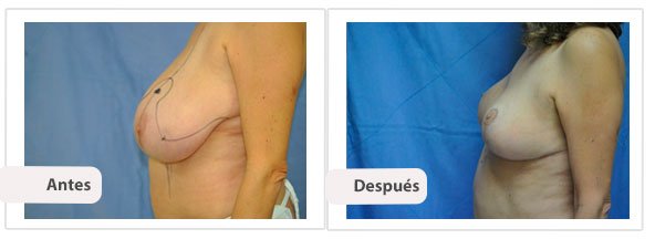 T invertida Mc Kissock: Perfil Caso 8