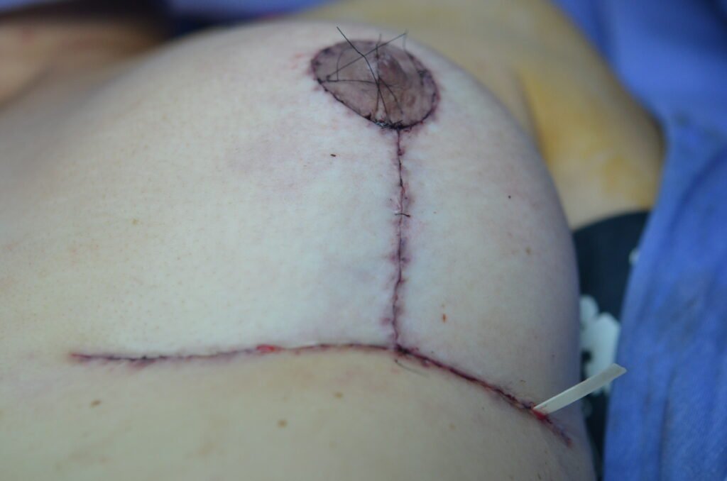 Mastopexia Post operatorio