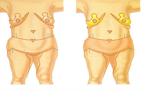 Abdominoplastía circunferencial