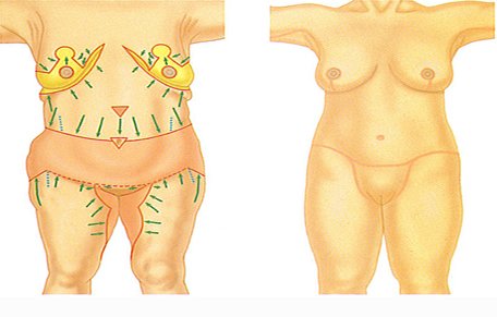 Abdominoplastía circunferencial