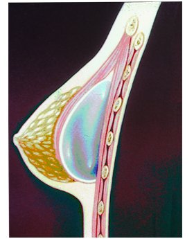 Posición Submuscular