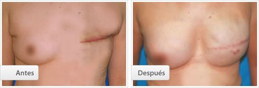 Reconstrucción Mamaria: Caso 1