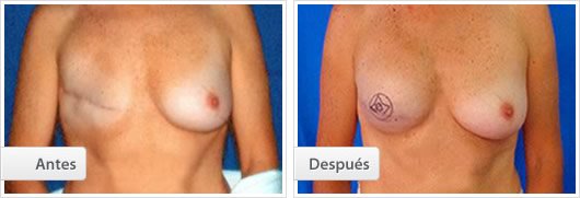 Reconstrucción Mamaria: Caso 2