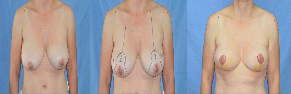 Refinamientos de Mc Kissock - Foto Comparativa