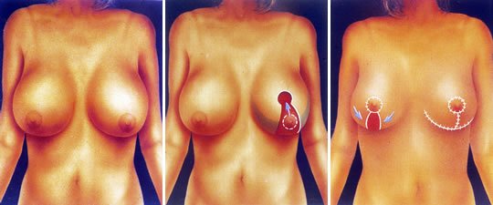 Refinamientos de Mc Kissock - Esquema