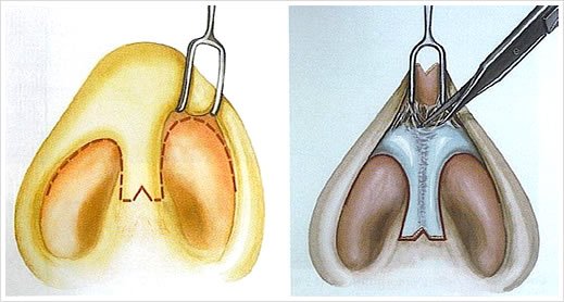 Rinoplastía Abierta