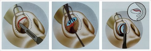 Rinoplastía Abierta