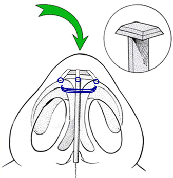Modificación de la Técnica del Umbrella Graft de Peck