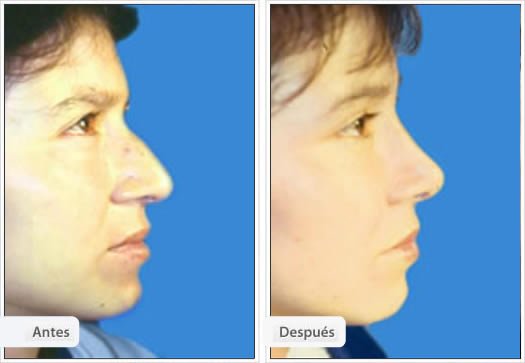 Rinoplastía Primaria: Caso 8