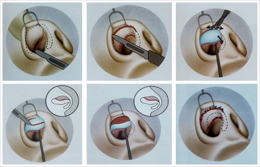 Rinoplastía Cerrada con Visualización Abierta