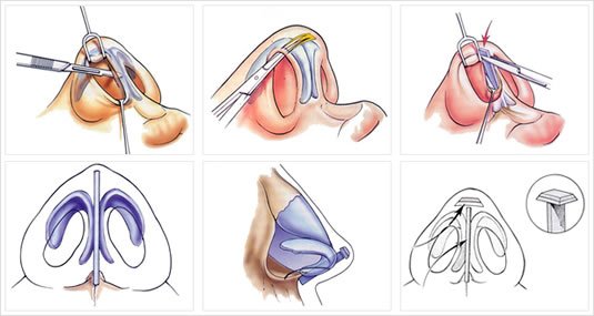Técnica de Peck: Umbrella Graft