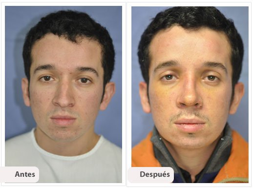 Desviación del Septum Nasal: Caso 1