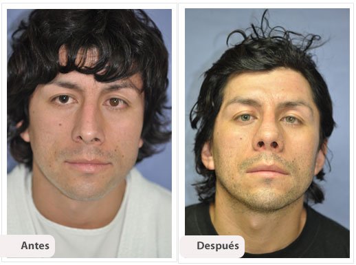 Desviación del Septum Nasal: Caso 2