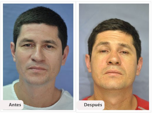 Desviación del Septum Nasal: Caso 3