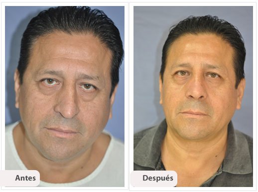 Desviación del Septum Nasal: Caso 9