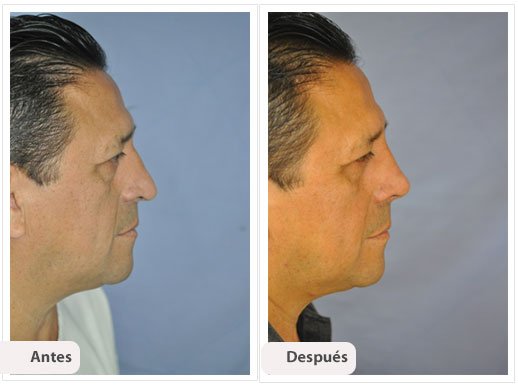Desviación del Septum Nasal: Perfil Caso 9