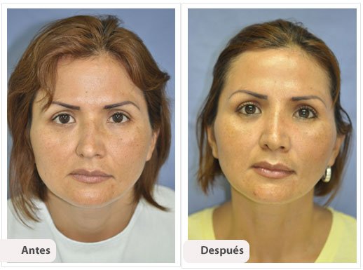 Desviación del Septum Nasal: Caso 4
