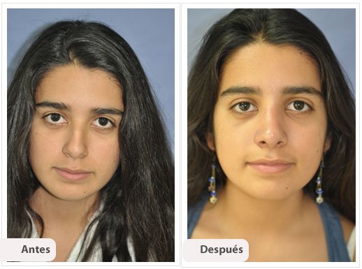 Desviación del Septum Nasal: Caso 5