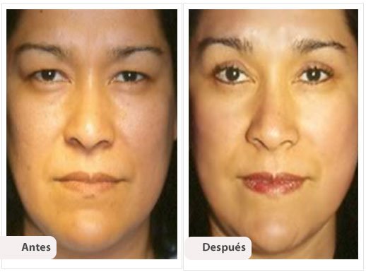 Ritidectomía: Caso 7