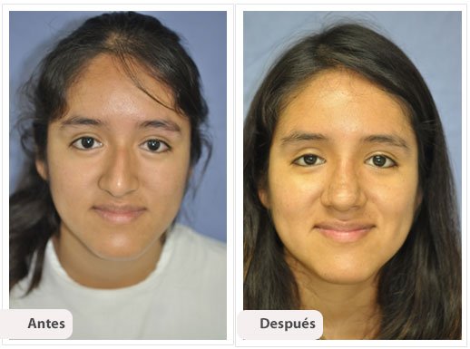 Desviación del Septum Nasal: Caso 6