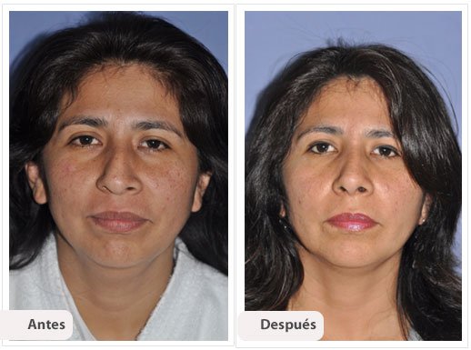 Desviación del Septum Nasal: Caso 7