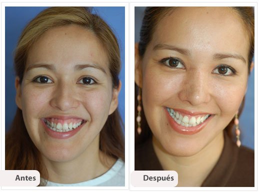 Rinoplastía Primaria: Caso 1