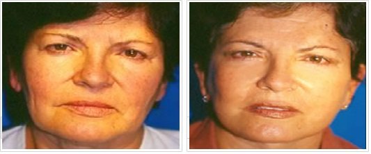 Ritidectomía: Caso 10