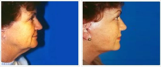 Ritidectomía: Perfil Caso 4