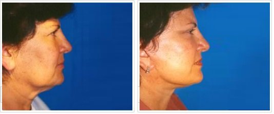 Ritidectomía: perfil Caso 10