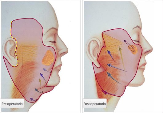 Ritidectomia Multiplano de Acceso Mínimo: Pre y Post Operatorio