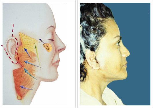 Técnica Moderna: Post Operatorio