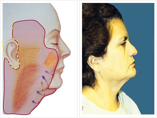 Técnica Moderna: Pre Operatorio
