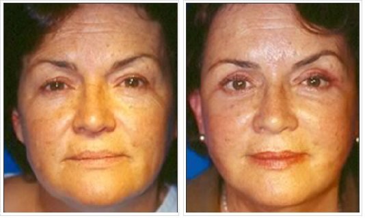 Ritidectomía: Caso 4