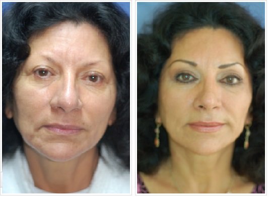 Ritidectomía: Caso 5