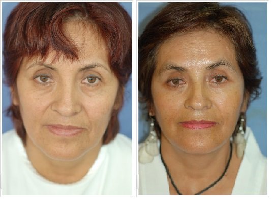 Ritidectomía: Caso 6