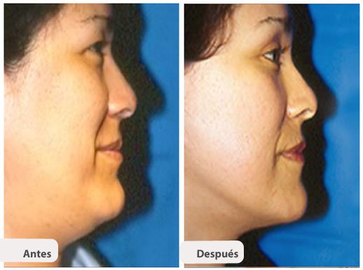 Ritidectomía: Perfil Caso 7