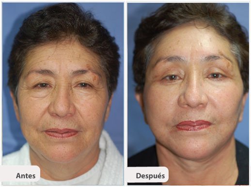 Ritidectomía: Caso 8