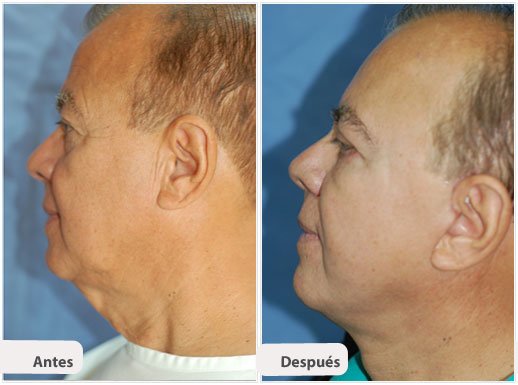 Ritidectomía: Caso 9