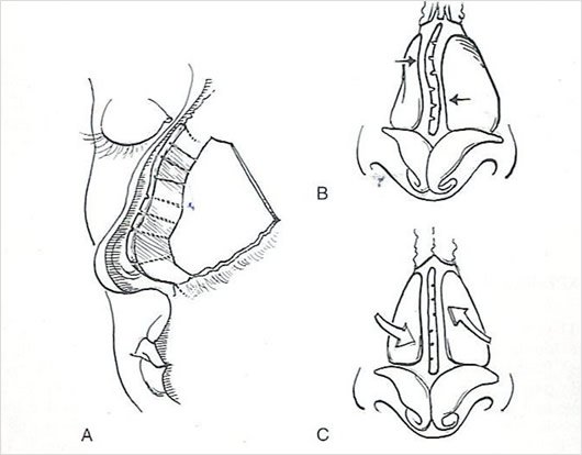 Desviación del Septum Nasal: Técnica Clásica