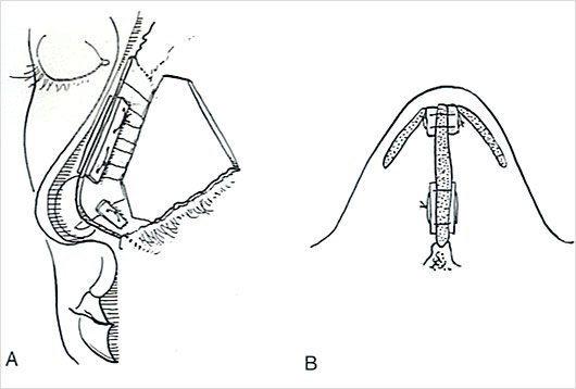 Desviación del Septum Nasal: Técnica Moderna