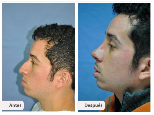 Desviación del Septum Nasal Perfil: Caso 1