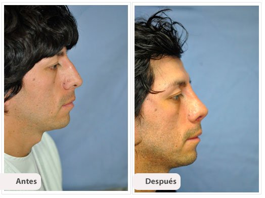 Desviación del Septum Nasal: Perfil Caso 2