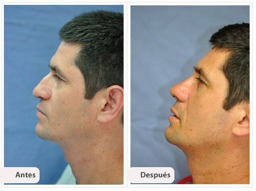 Desviación del Septum Nasal: Perfil Caso 3