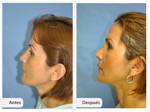 Desviación del Septum Nasal: Perfil Caso 4