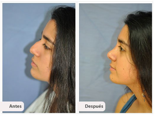 Desviación del Septum Nasal: Perfil Caso 5